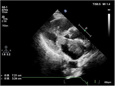Case Report: Assessment of primary myxofibrosarcoma in the left atrium using multimodal ultrasonography